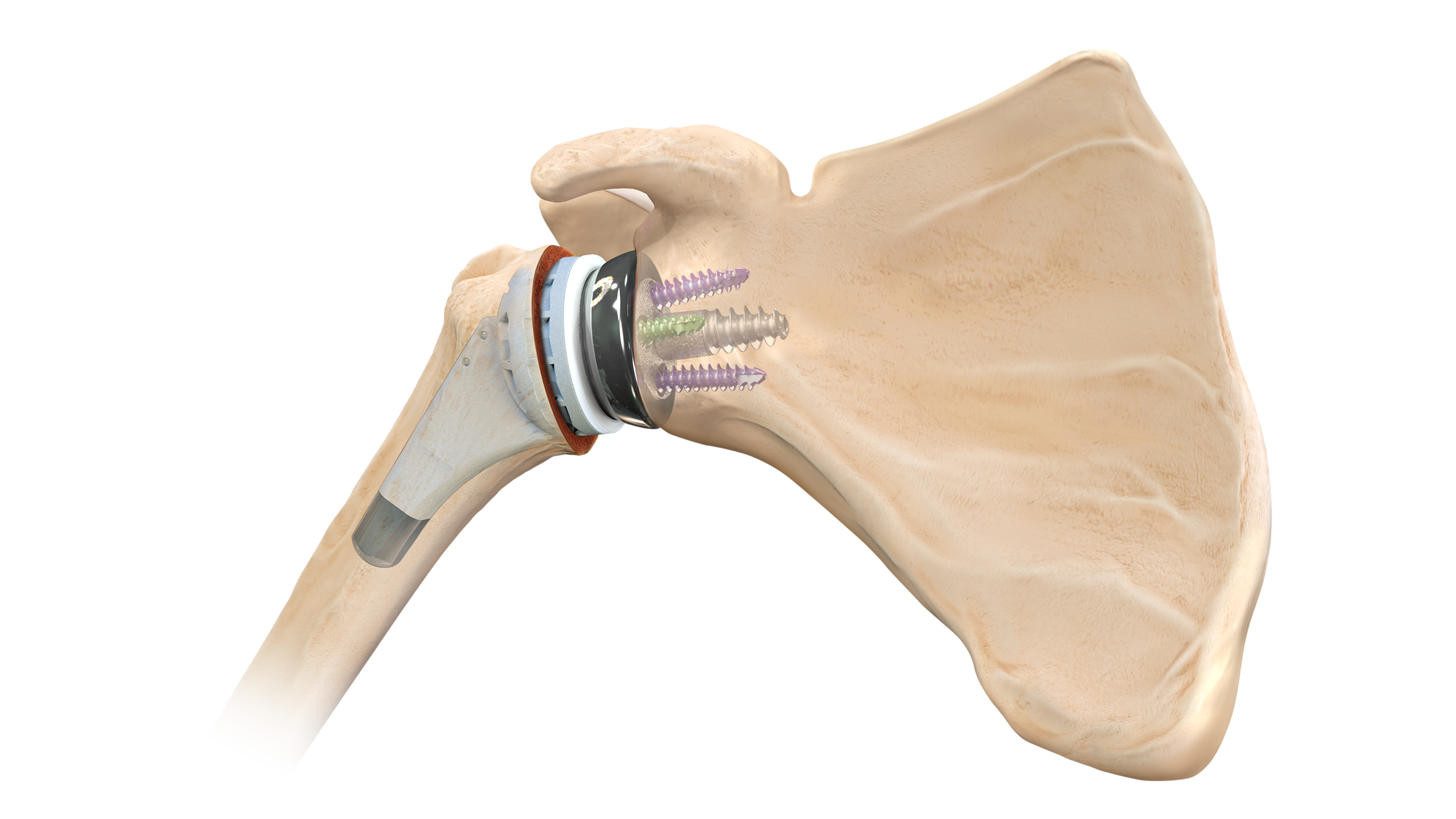 Shoulder Replacement Homepage